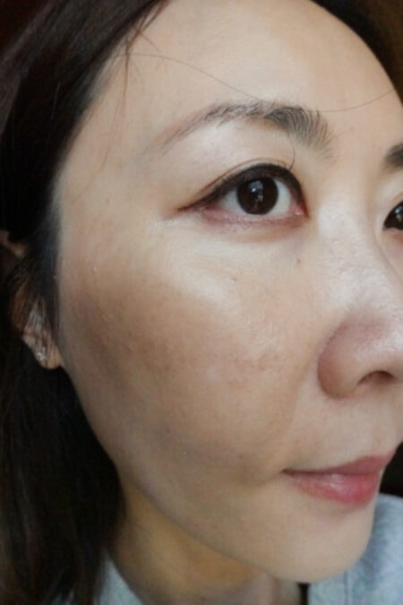 【台北】松江南京|台北彥靚診所,Picocare皮秒雷射+蜂巢探頭,細緻肌膚淡化瑕疵,台北皮秒推薦 - 第9張圖 【台北】松江南京|台北彥靚診所,Picocare皮秒雷射+蜂巢探頭,細緻肌膚淡化瑕疵,台北皮秒推薦