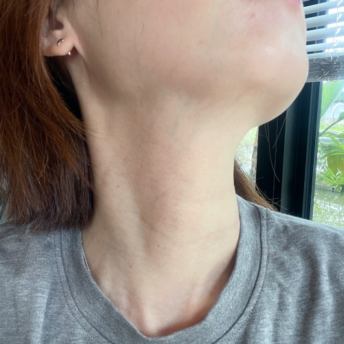 【台北】粹究美學|EXION 時空E電波,最新微針電波超有感緊緻頸紋、細緻毛孔 - 第40張圖