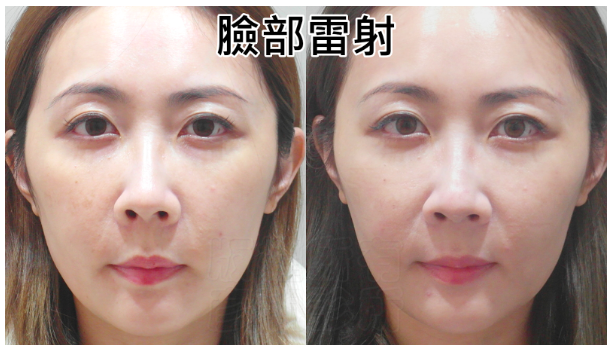 【台北】松江南京｜台北彥靚診所，Picocare皮秒雷射＋蜂巢探頭，細緻肌膚淡化瑕疵，台北皮秒推薦