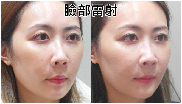 【台北】松江南京|台北彥靚診所,Picocare皮秒雷射+蜂巢探頭,細緻肌膚淡化瑕疵,台北皮秒推薦 - 第33張圖 【台北】松江南京|台北彥靚診所,Picocare皮秒雷射+蜂巢探頭,細緻肌膚淡化瑕疵,台北皮秒推薦