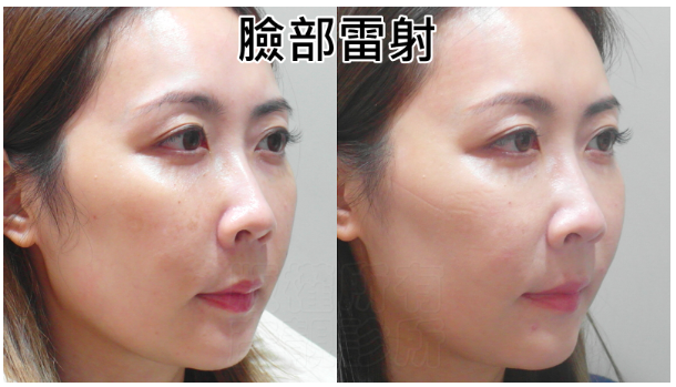 【台北】松江南京｜台北彥靚診所，Picocare皮秒雷射＋蜂巢探頭，細緻肌膚淡化瑕疵，台北皮秒推薦