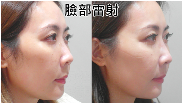 【台北】松江南京｜台北彥靚診所，Picocare皮秒雷射＋蜂巢探頭，細緻肌膚淡化瑕疵，台北皮秒推薦